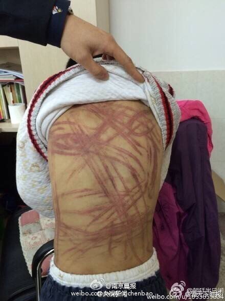 南京虐童案少年被打偏题鳞伤