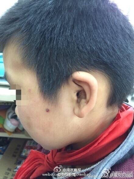 南京虐童案少年被打偏题鳞伤