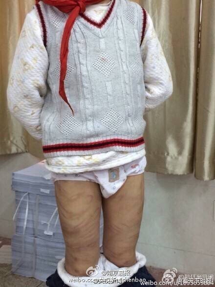 南京虐童案少年被打偏题鳞伤