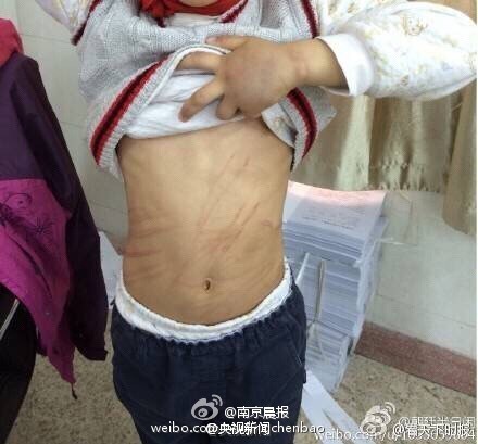 南京虐童案少年被打偏题鳞伤